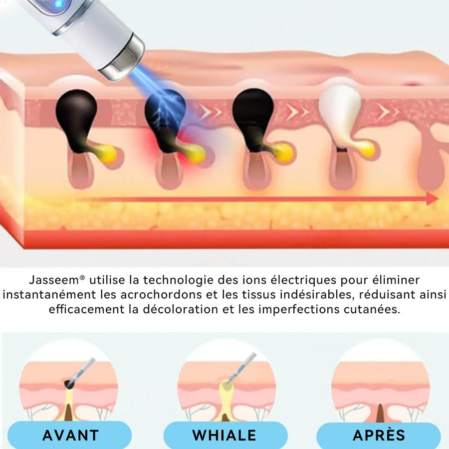 𝐉𝐚𝐬𝐬𝐞𝐞𝐦® Stylo Laser de Qualité Médicale 🎉 (utilise la technologie laser au CO₂ – efficace pour éliminer les grains de beauté, les verrues, les acrochordons, les taches pigmentaires et autres imperfections)🏆