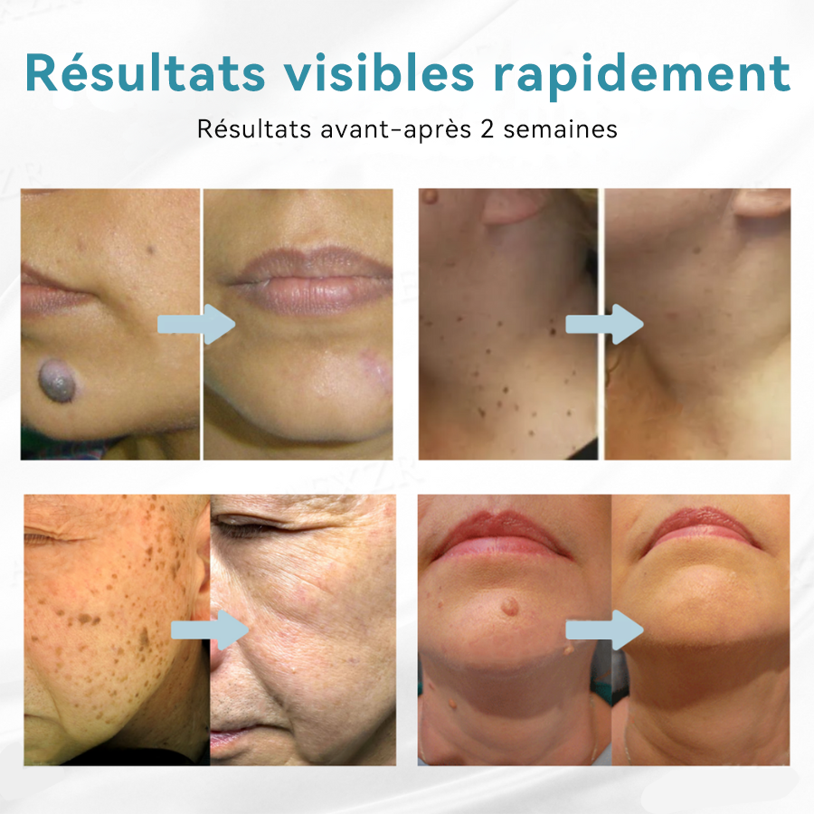 𝐉𝐚𝐬𝐬𝐞𝐞𝐦® Stylo Laser de Qualité Médicale 🎉 (utilise la technologie laser au CO₂ – efficace pour éliminer les grains de beauté, les verrues, les acrochordons, les taches pigmentaires et autres imperfections)🏆