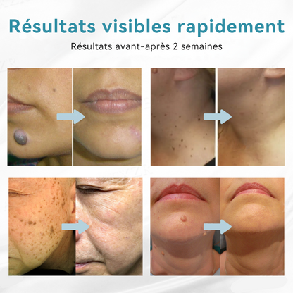 𝐉𝐚𝐬𝐬𝐞𝐞𝐦® Stylo Laser de Qualité Médicale 🎉 (utilise la technologie laser au CO₂ – efficace pour éliminer les grains de beauté, les verrues, les acrochordons, les taches pigmentaires et autres imperfections)🏆