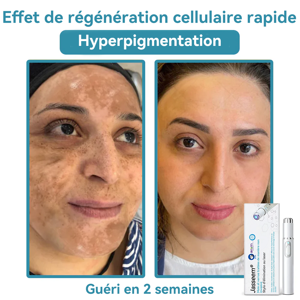 𝐉𝐚𝐬𝐬𝐞𝐞𝐦® Stylo Laser de Qualité Médicale 🎉 (utilise la technologie laser au CO₂ – efficace pour éliminer les grains de beauté, les verrues, les acrochordons, les taches pigmentaires et autres imperfections)🏆