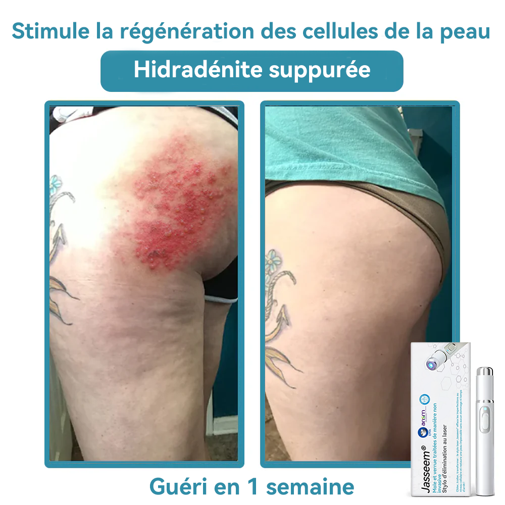 𝐉𝐚𝐬𝐬𝐞𝐞𝐦® Stylo Laser de Qualité Médicale 🎉 (utilise la technologie laser au CO₂ – efficace pour éliminer les grains de beauté, les verrues, les acrochordons, les taches pigmentaires et autres imperfections)🏆