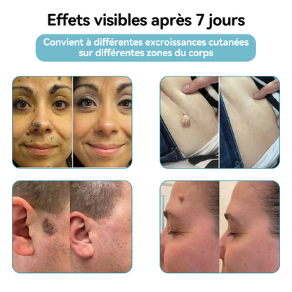 𝐉𝐚𝐬𝐬𝐞𝐞𝐦® Stylo Laser de Qualité Médicale 🎉 (utilise la technologie laser au CO₂ – efficace pour éliminer les grains de beauté, les verrues, les acrochordons, les taches pigmentaires et autres imperfections)🏆