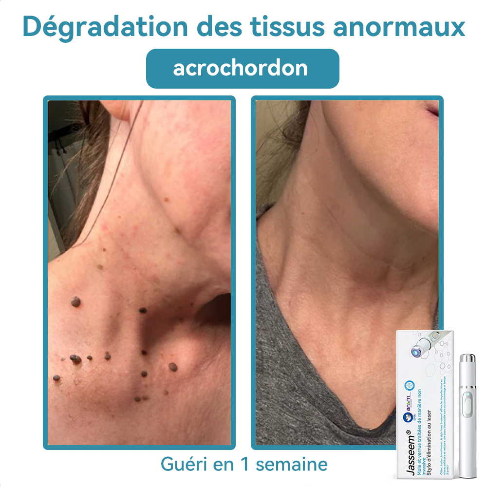 𝐉𝐚𝐬𝐬𝐞𝐞𝐦® Stylo Laser de Qualité Médicale 🎉 (utilise la technologie laser au CO₂ – efficace pour éliminer les grains de beauté, les verrues, les acrochordons, les taches pigmentaires et autres imperfections)🏆