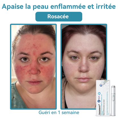 𝐉𝐚𝐬𝐬𝐞𝐞𝐦® Stylo Laser de Qualité Médicale 🎉 (utilise la technologie laser au CO₂ – efficace pour éliminer les grains de beauté, les verrues, les acrochordons, les taches pigmentaires et autres imperfections)🏆